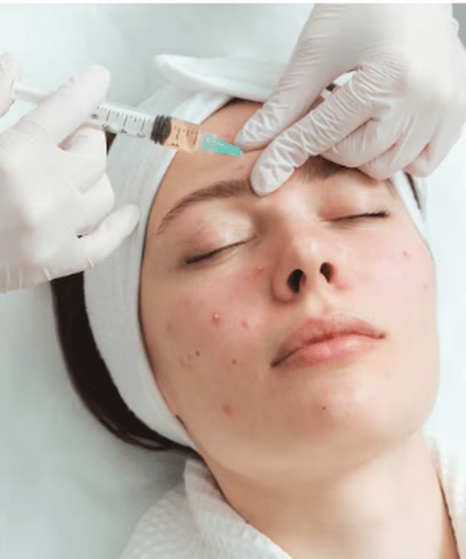 Acne treatment